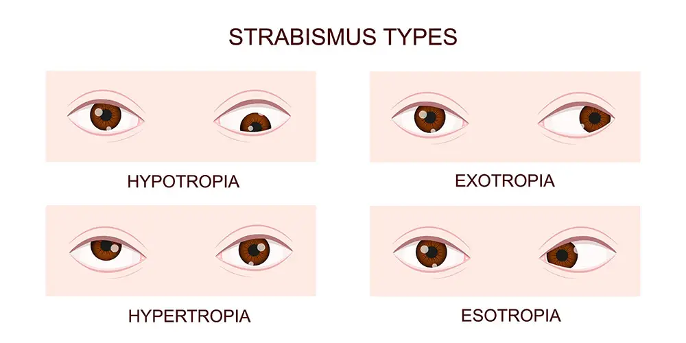Strabismus - Santa Monica Eye Group